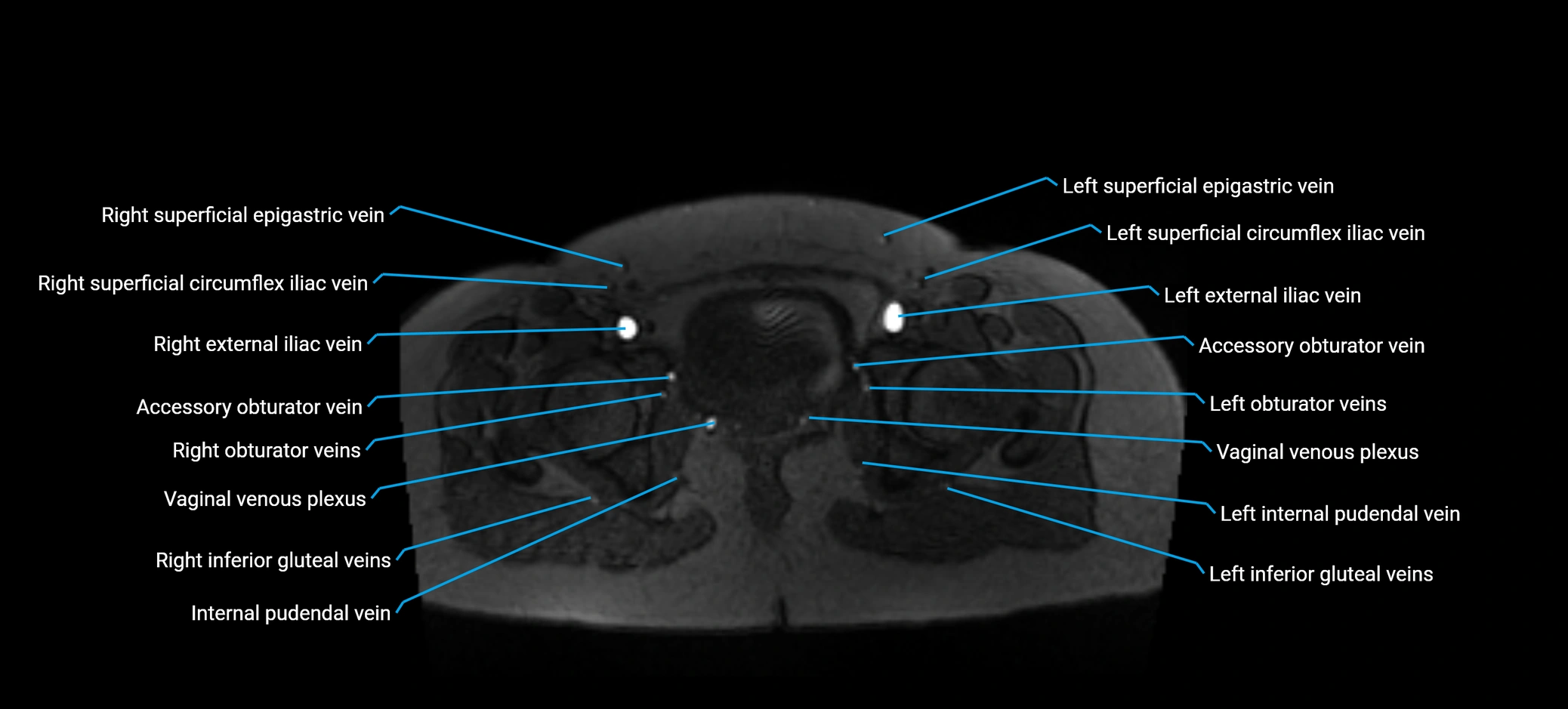 MRV abdomen pelvis & lower limb axial cross sectional anatomy labelled MRI image 183 (1).webp